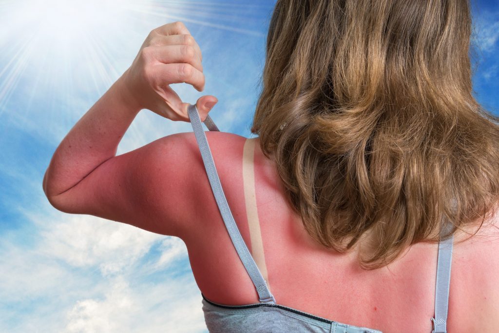 Insolazione Sintomi E Differenza Col Colpo Di Calore Ohga