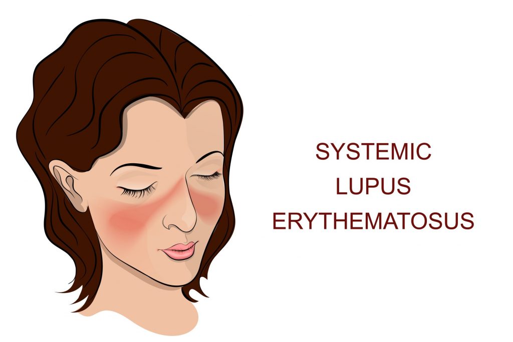 Lupus eritematoso sistemico (LES) cos'è, sintomi