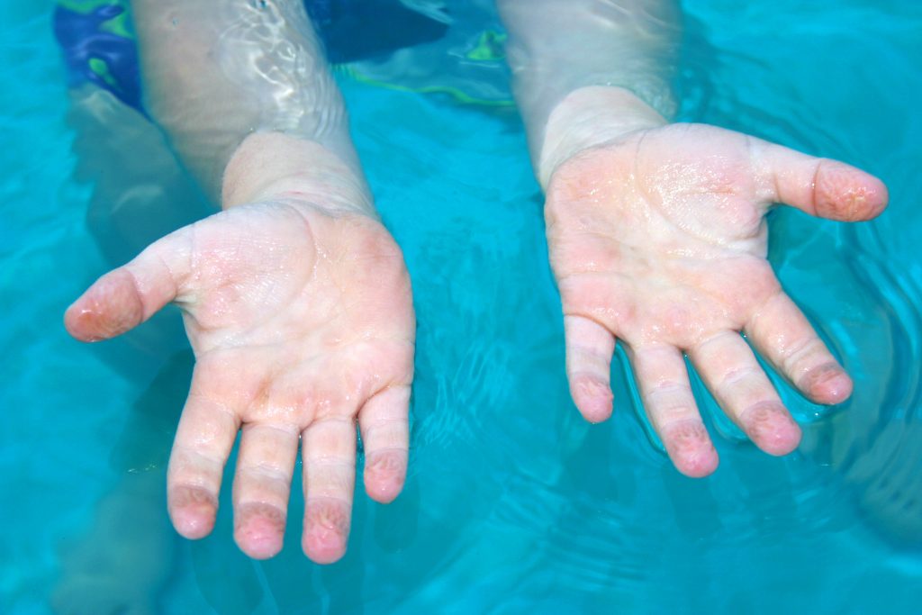Perchè Le Mani Nell Acqua Raggrinziscono