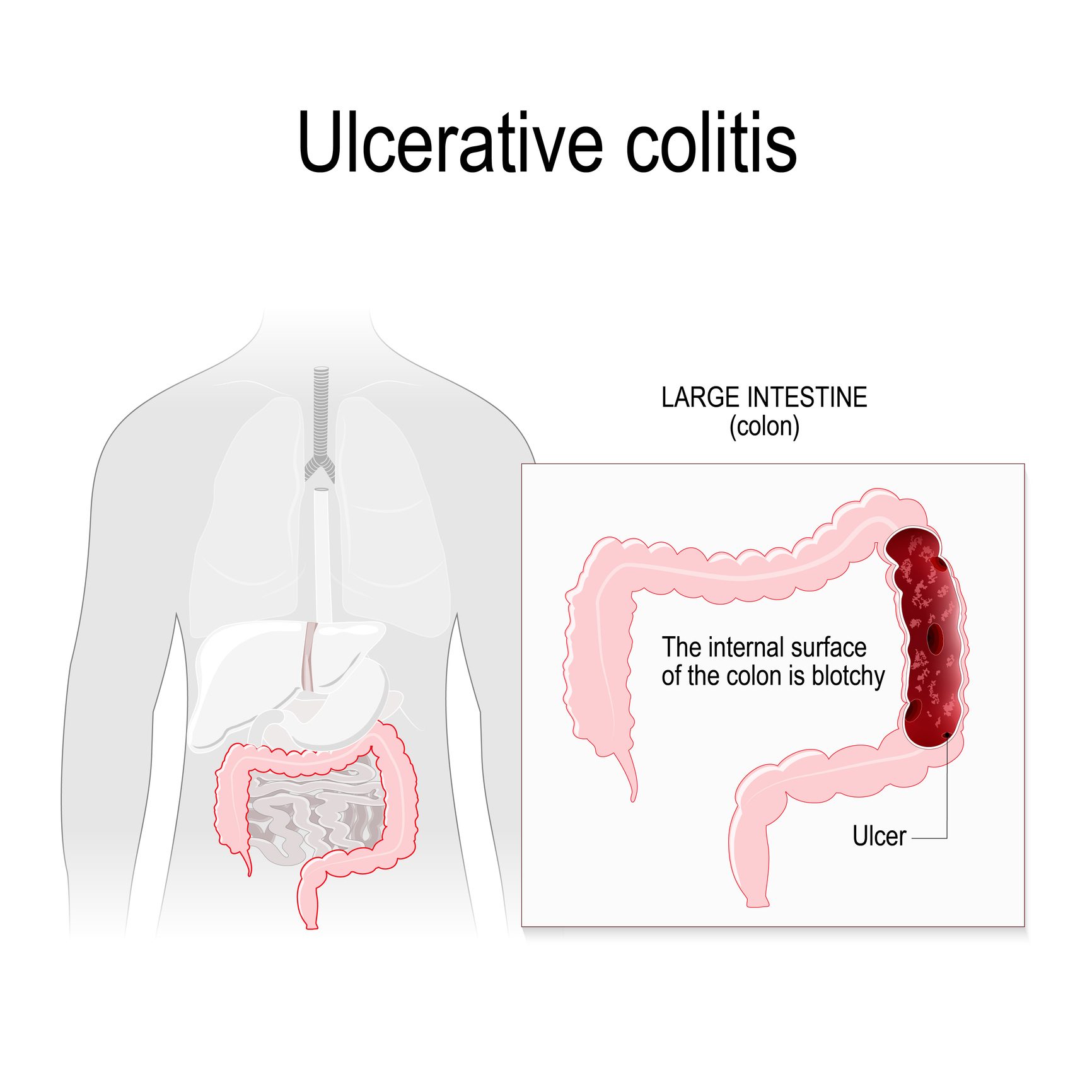 La colite ulcerosa qual è la differenza rispetto al morbo di Crohn Ohga! La colite ulcerosa qual è la differenza rispetto al morbo di Crohn Ohga!
