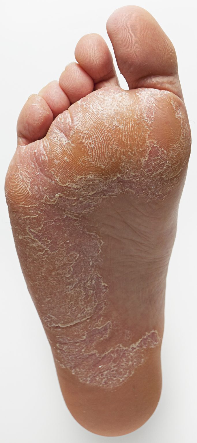 Piede d'atleta come riconoscerlo e come si cura Ohga!