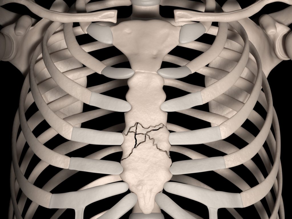 Frattura dello sterno le cause, i sintomi e la cura Ohga!