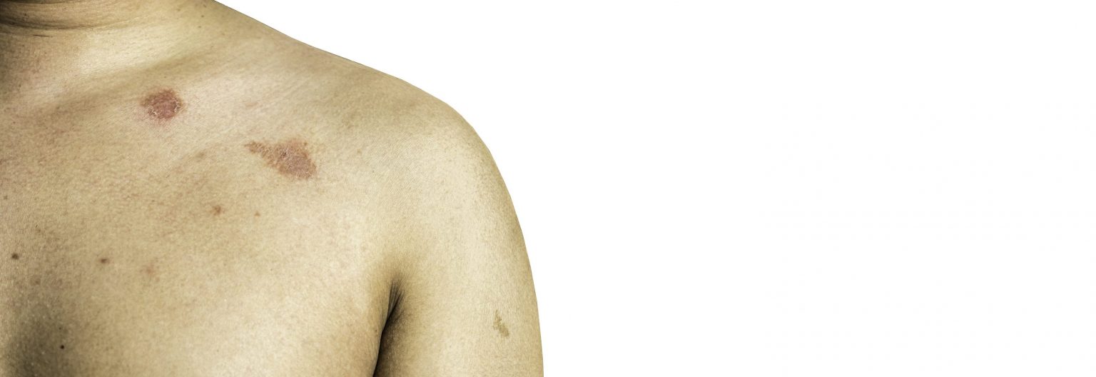 Cos è Lo Strabismo Di Venere