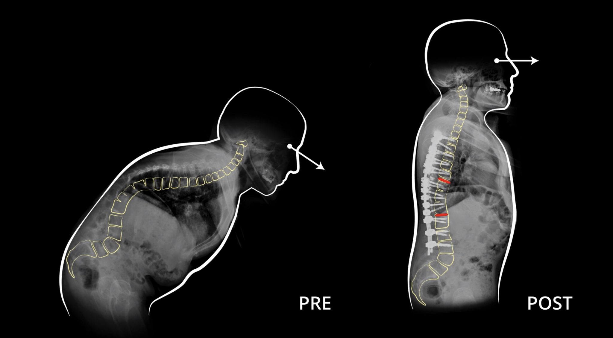 Intervento da record al Rizzoli di Bologna corretta una cifosi con