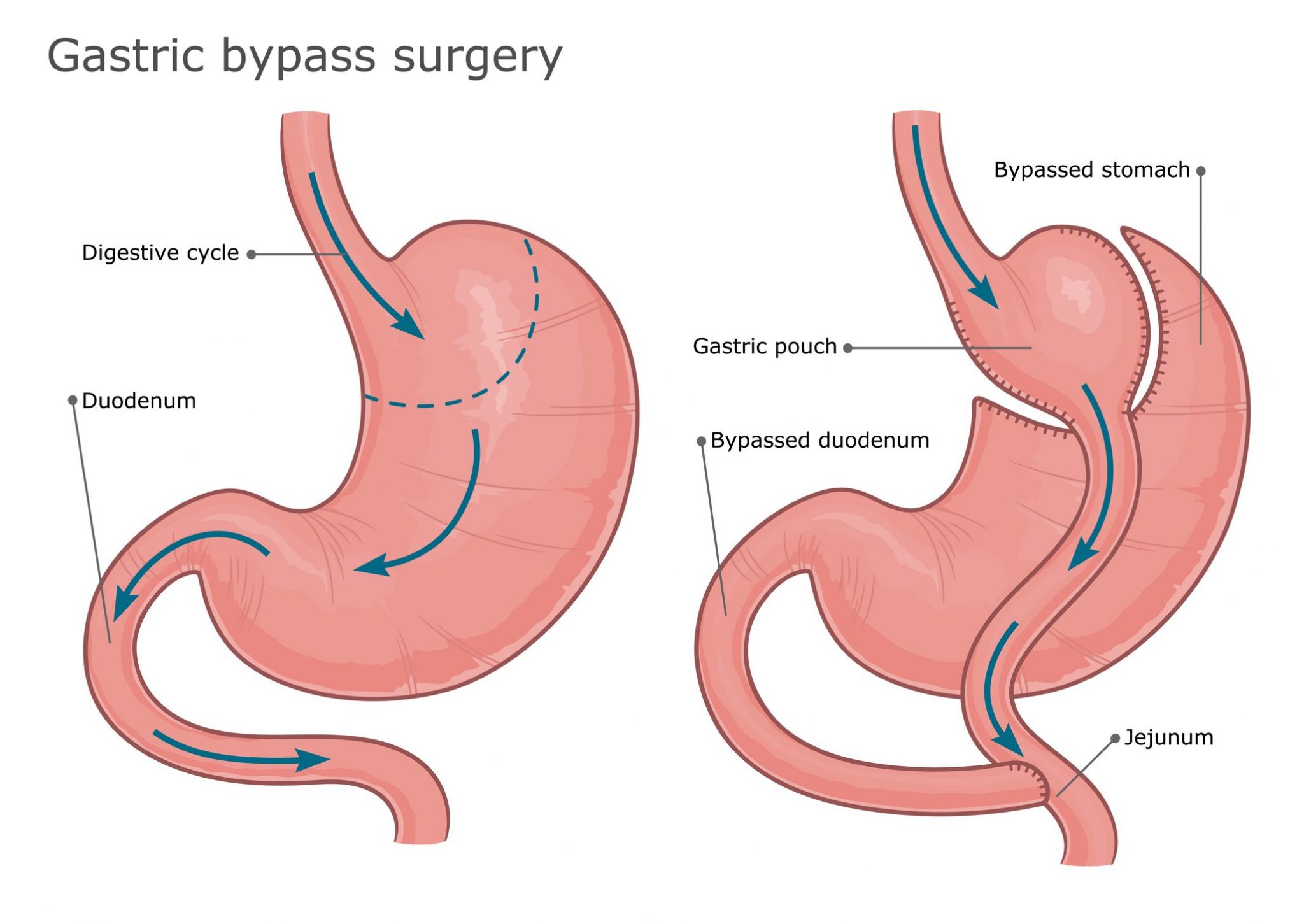 Bypass gastrico che cos'è, a cosa serve e quando farlo Ohga!
